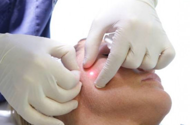 Endolift