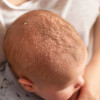 Bebeklerde ve Çocuklarda Konak (Seboreik Dermatit)