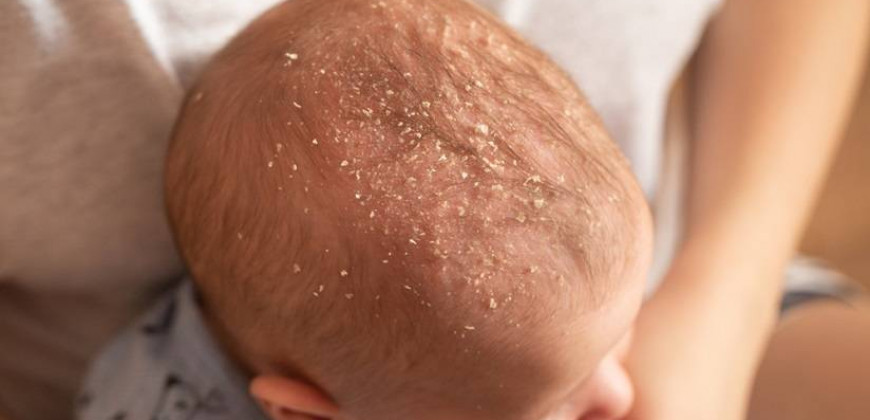 Bebeklerde ve Çocuklarda Konak (Seboreik Dermatit)