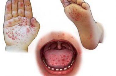 El ayak ağız hastalığı