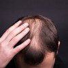 Androgenetik Alopesi (Erkek tipi saç dökülmesi)