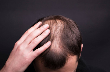 Androgenetik Alopesi (Erkek tipi saç dökülmesi)