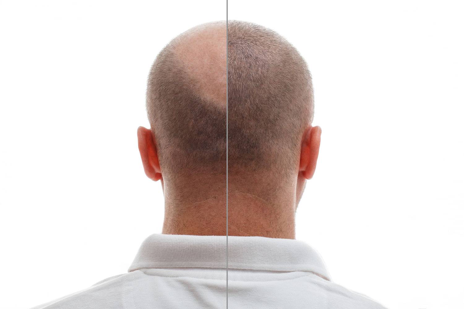 Androgenerik Alopesi 