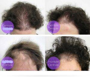 Androgenetik Alopesi Erkek Tipi Sac Dokulmesi