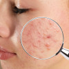 Kozmetik aknesi (akne kozmetika, acne cosmetica)