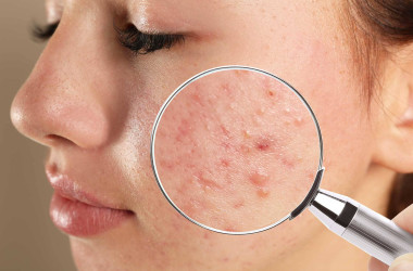 Kozmetik aknesi (akne kozmetika, acne cosmetica)