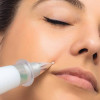 Plazma Pen (Plazma kalemi) nedir?