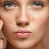 Retinoidler nedir? Retinoidler neden kullanılır?