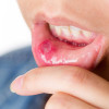 Tekrarlayan ağız içi yaraları (tekrarlayan oral aftlar)