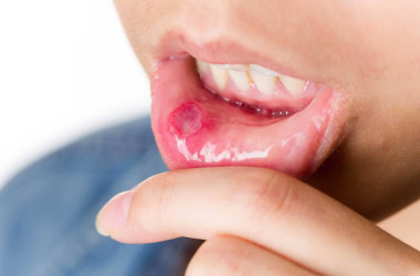 Tekrarlayan ağız içi yaraları (tekrarlayan oral aftlar)
