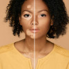 Vitiligo (Ala hastalığı, Alaca Hastalığı)