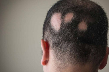 Saçkıran (Alopesi Areata) Hastalığı