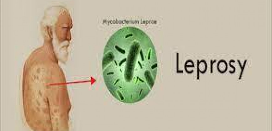 Cüzzam (Lepra) Hastalığı Nedir?