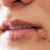Herpes (Uçuk) nedir ? Nasıl tedavi edilir?