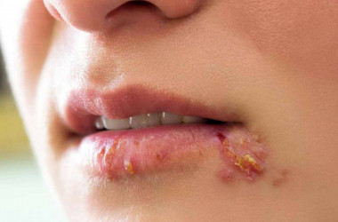 Herpes (Uçuk) nedir ? Nasıl tedavi edilir?