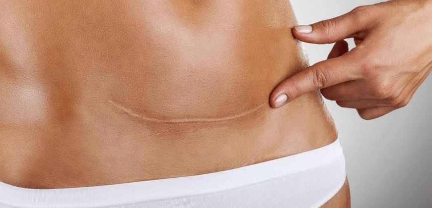 Keloid (yara izi) ile ilgili bilinmesi gerekenler
