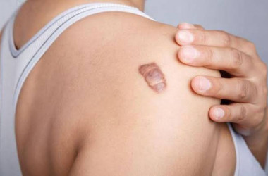 Keloid (Yara İzi) ile İlgili Bilinmesi Gerekenler