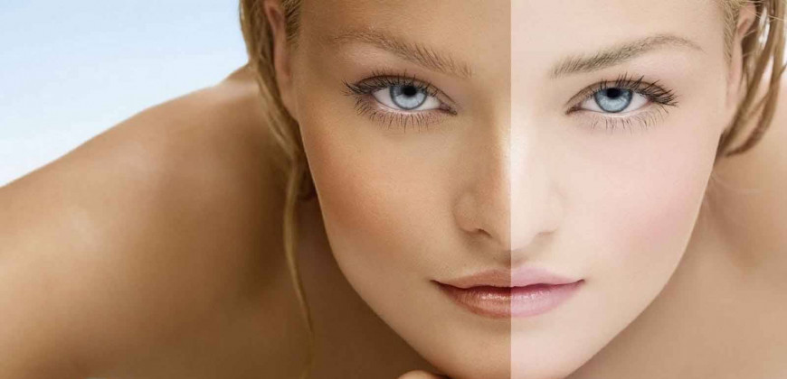 Lazer Karbon Peeling nedir?
