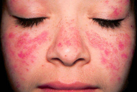 Lupus hastalığı (Kelebek hastalığı)