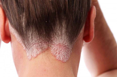 Sedef Hastalığı (Psoriasis)