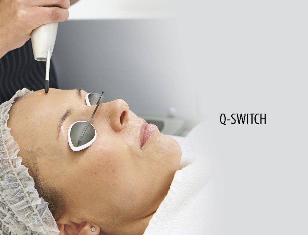 Q switch Lazerler